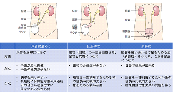 ろう 膀胱