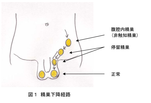 停留精巣 男児 福岡県泌尿器科医会